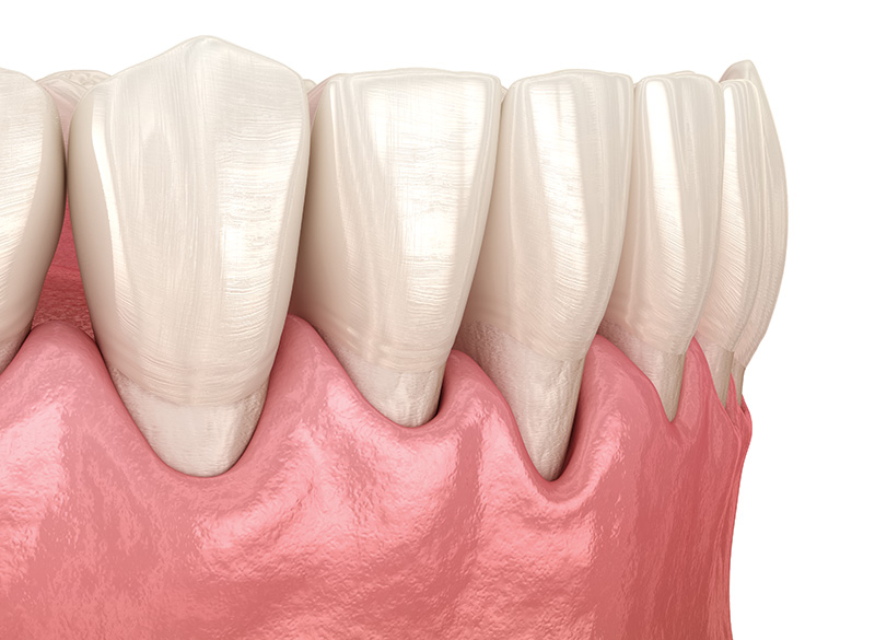 歯茎ピーリング