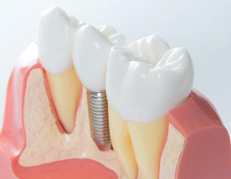 重度の骨不足でも、あきらめないために